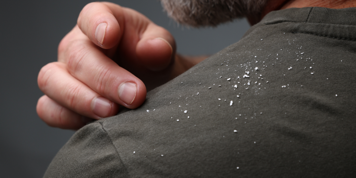 The Truth About Beard Dandruff