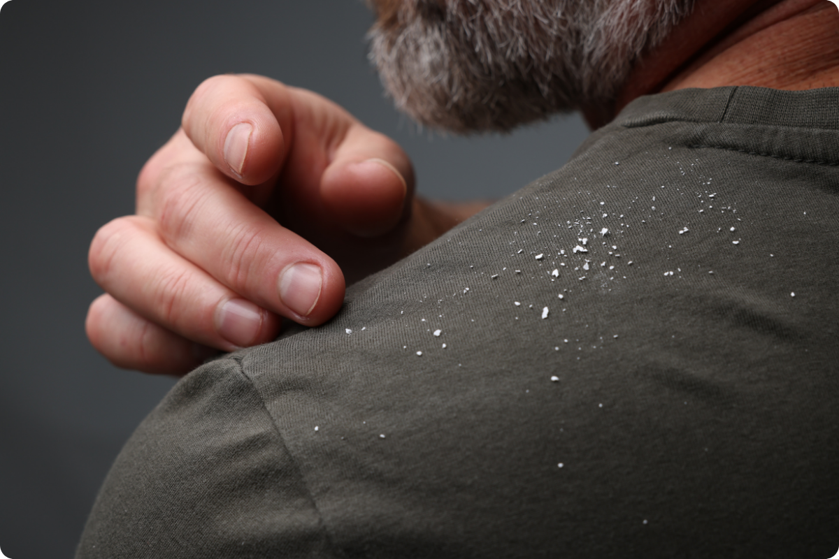 The Truth About Beard Dandruff
